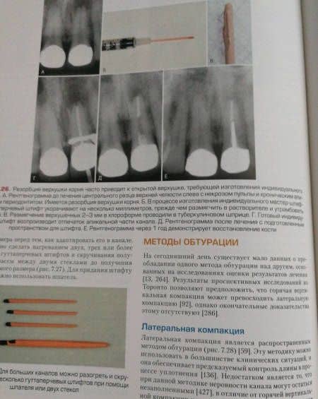 Эндодонтия. Руководство — Илан Ротштейн (2)