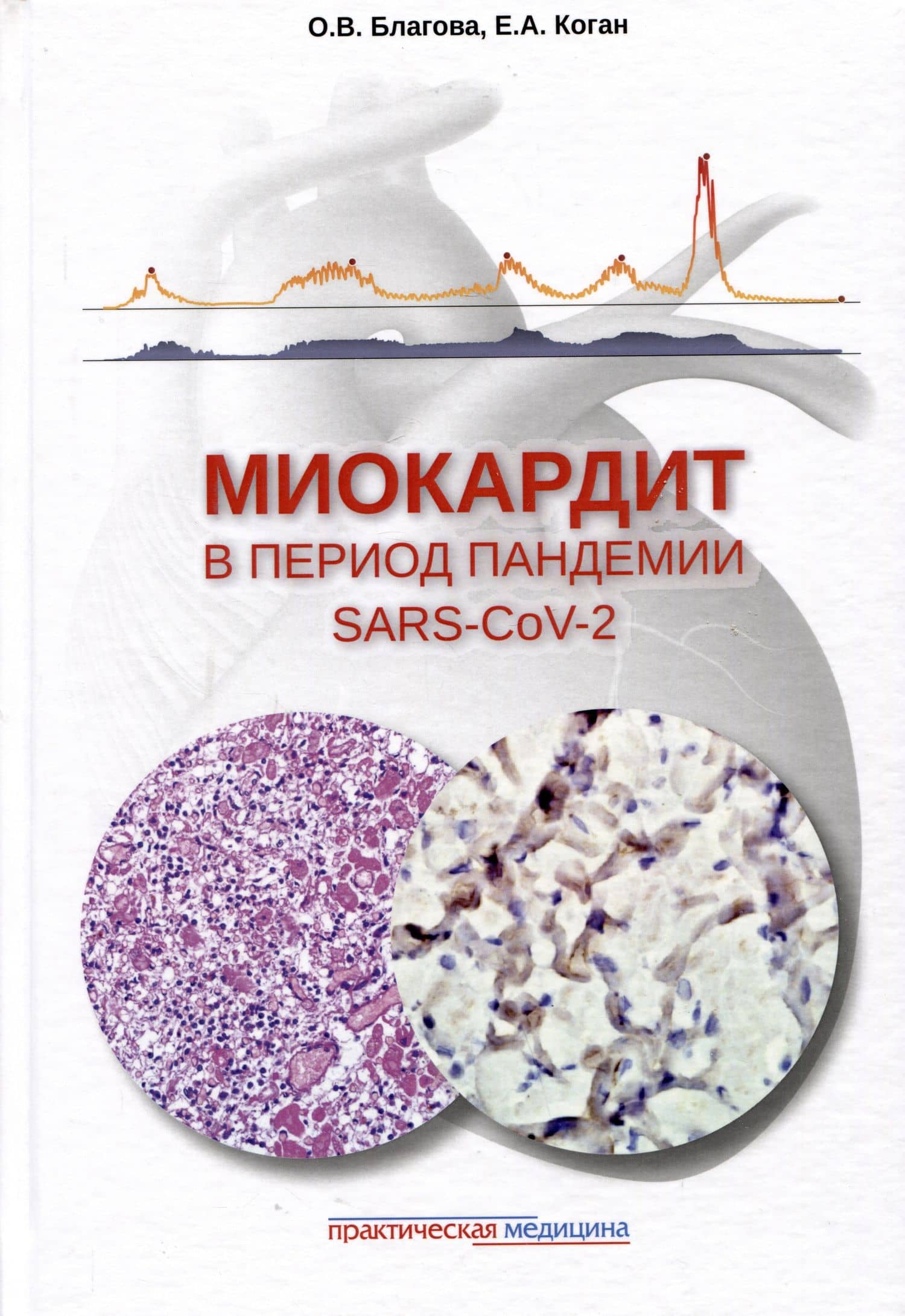 Миокардит в период пандемии SARS-CoV-2 — Ольга Владимировна Благова