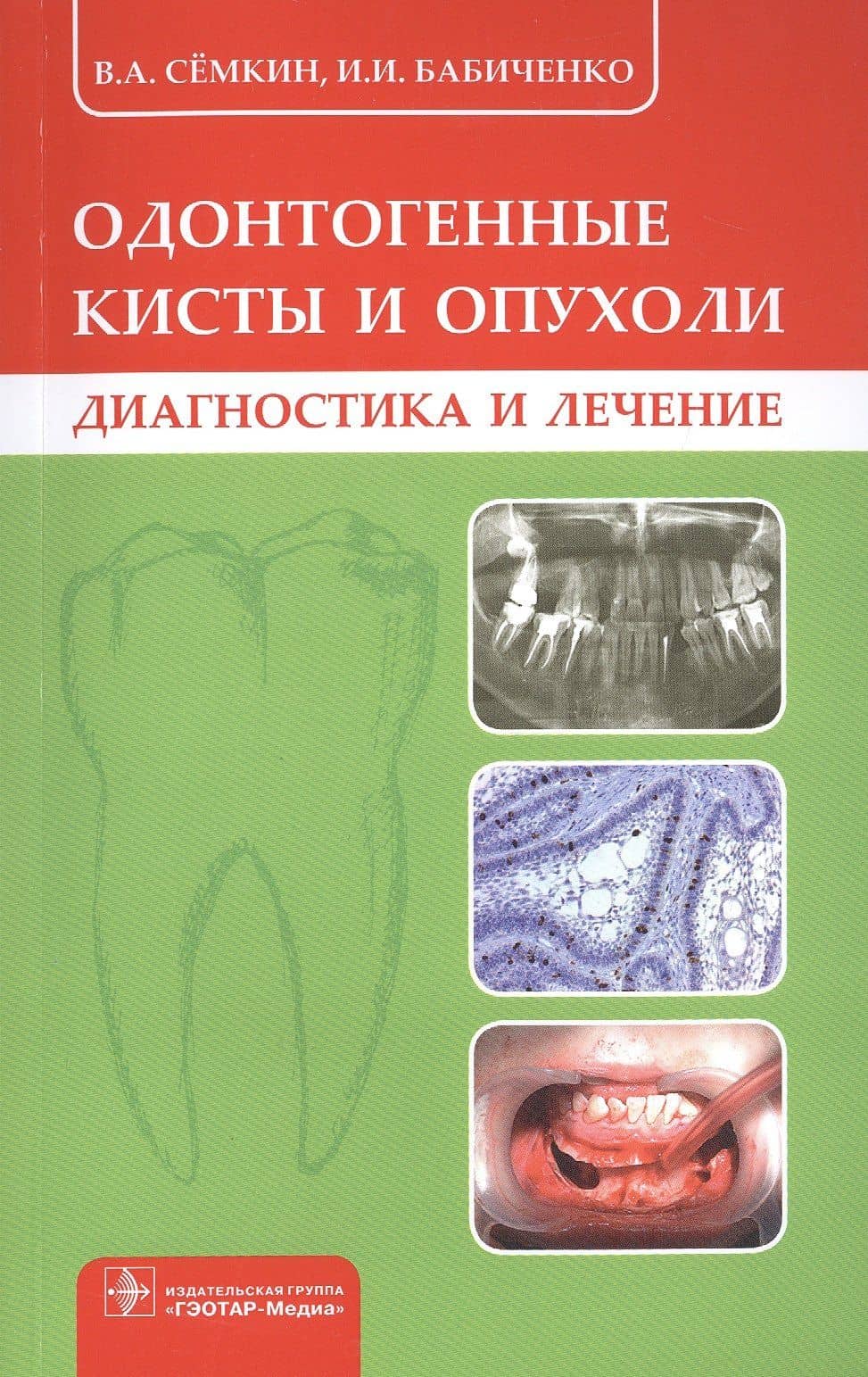 Одонтогенные кисты и опухоли. Диагностика и лечение