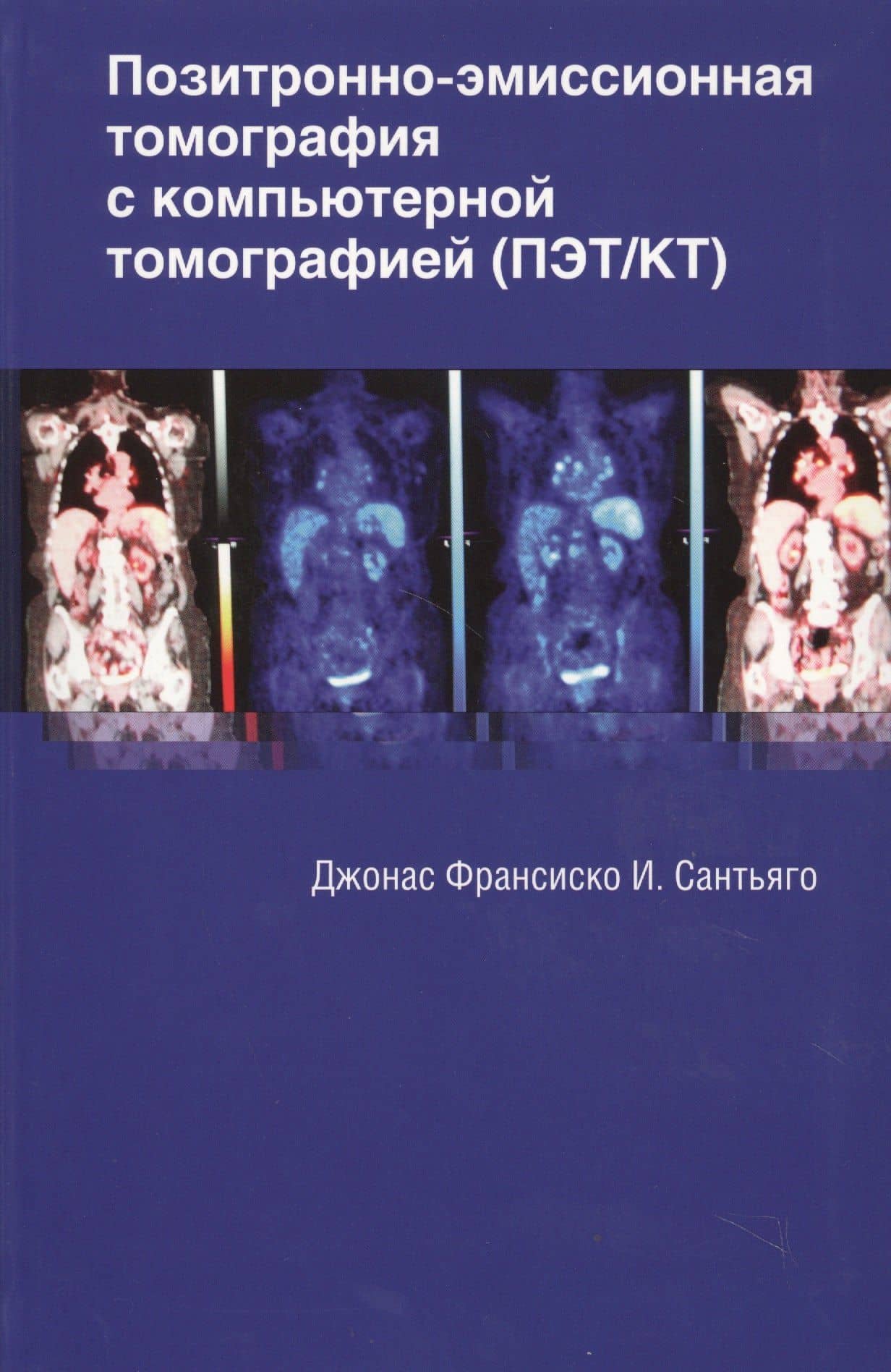Позитронно-эмиссионная томография с компьютерной томографией (ПЭТ/КТ) — Джонас Франсиско И. Сантьяго