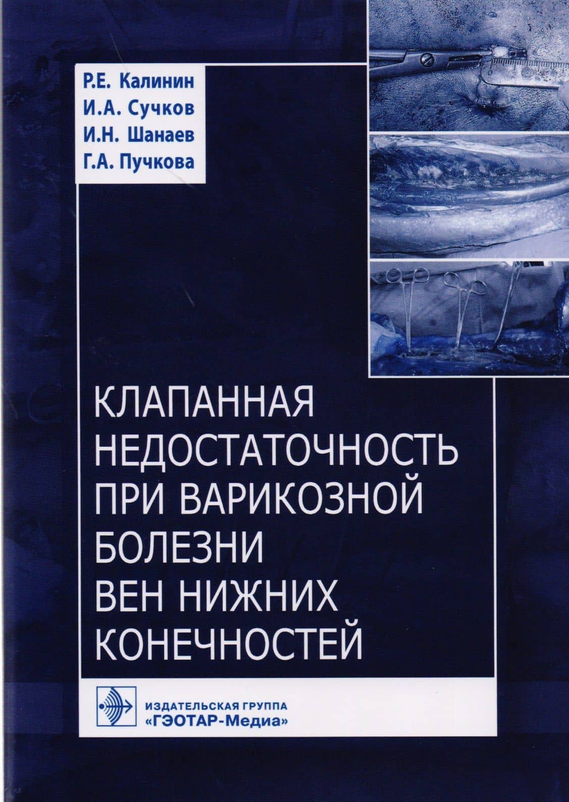 Клапанная недостаточность при варикозной болезни вен нижних конечностей