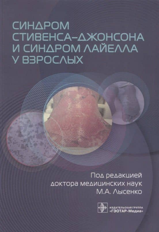 Синдром Стивенса–Джонсона и синдром Лайелла у взрослых — Марьяна Анатольевна Лысенко